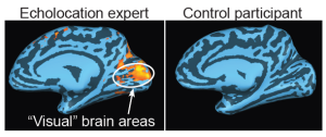 left image showing increased brain activity in occipital lobe for echolocation expert and right image showing no such increase in activity in a control participant