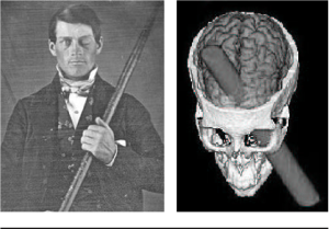 side-by-side images, with left image depicting Phineas Gage holding the tamping rod and the left image showing where that rod had entered his skull below the left eye and exited through the right side of the frontal lobe