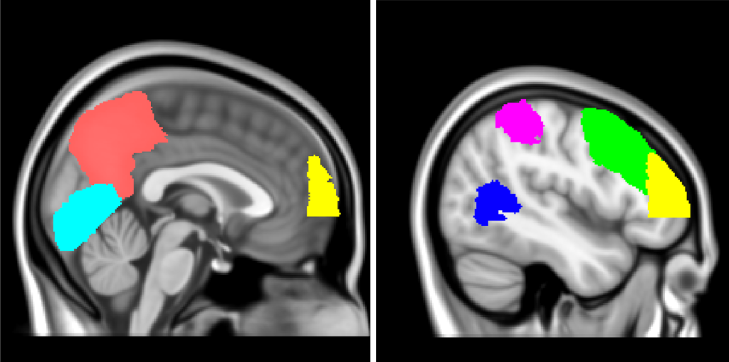 Two panels with T1-weighted MRI images. Coloured regions are overlaid as per the caption.