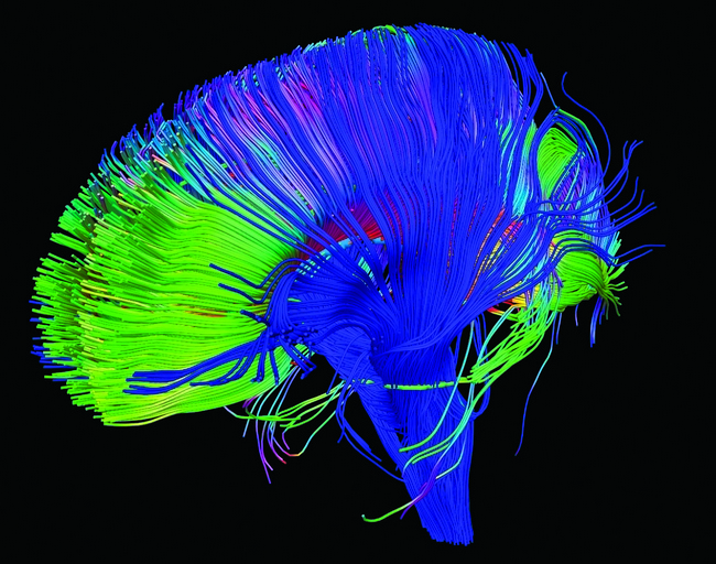 A tractogram showing white matter pathways of the brain.